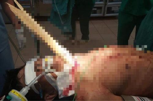 Cứu sống người đàn ông bị thanh gỗ nửa mét đâm xuyên cổ