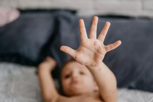 Thủy đậu có mấy giai đoạn? Các giai đoạn khác biệt như thế nào?