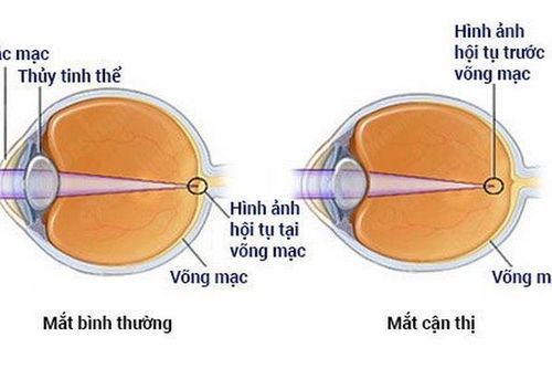 Kiểm soát tiến triển cận thị ở trẻ em