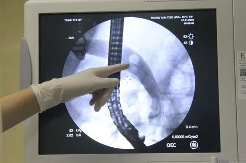 Nội soi mật tụy ngược dòng cứu bệnh nhân 91 tuổi