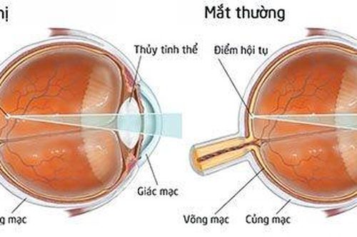 Atropine nhỏ mắt có làm chậm lại tiến triển cận thị ở trẻ em?