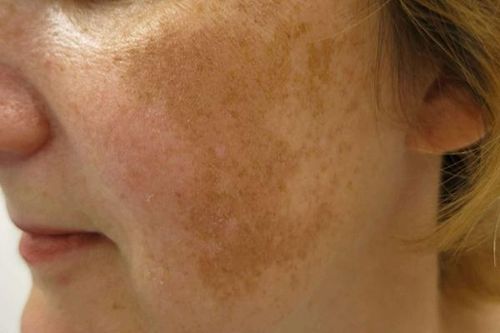 Rám má và cuộc chiến dai dẳng với những gam màu tối