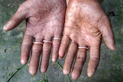 Giải mã bí ẩn về những người không có dấu vân tay