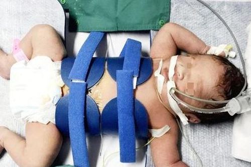 Hạ thân nhiệt cứu trẻ sơ sinh bị thiếu máu não