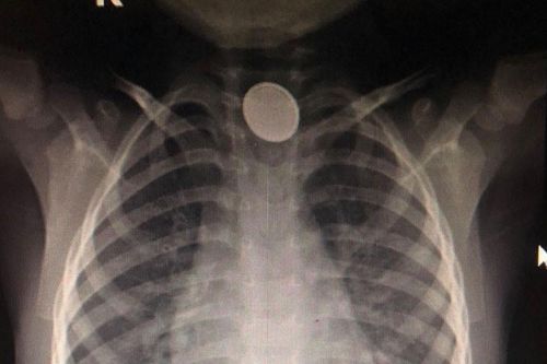 Bé trai 4 tuổi bỏng thực quản do nuốt pin