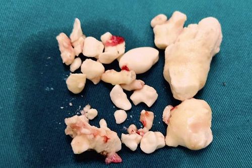 Nghiện rượu từ cấp 3, người đàn ông tích đầy sỏi trong tụy