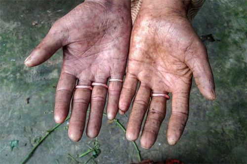 Hội chứng không có dấu vân tay khiến nhiều người khốn khổ