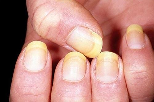 Cách 'xử lý' móng tay ngả vàng đơn giản nhất