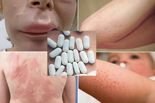 Cách dùng thuốc chống dị ứng an toàn