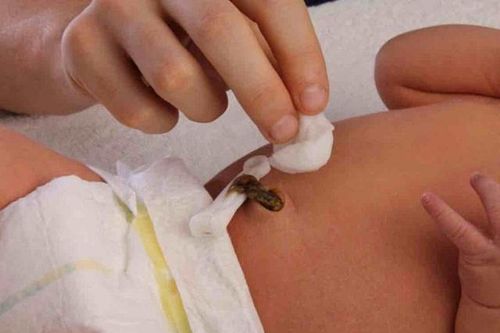 Sinh tại nhà được cắt rốn bằng kéo, bé 9 ngày tuổi bị uốn ván nặng