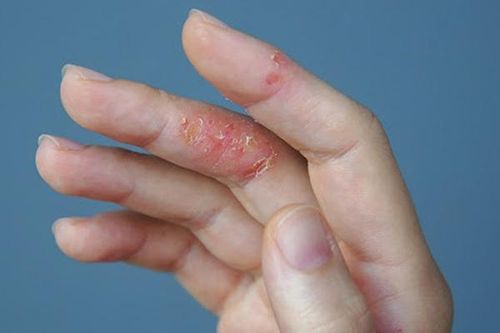 ThS.BS Huỳnh Thị Thanh Thùy - Khoa Khám Bệnh, BV Da Liễu TP.HCM Nhiều bệnh về da dễ bùng phát trong mùa lạnh