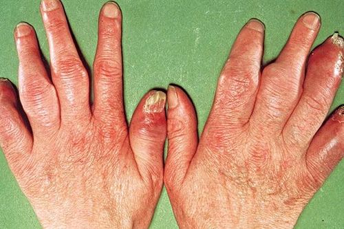 Mối tương hệ giữa bệnh ở hệ cơ xương khớp và da liễu