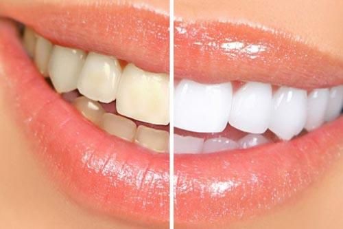 Răng bạn có vàng ố tới mấy cũng trắng ngay lập tức khi dùng chanh cách này