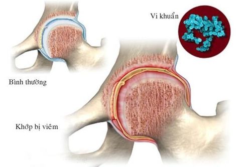 Chớ xem thường viêm khớp nhiễm khuẩn