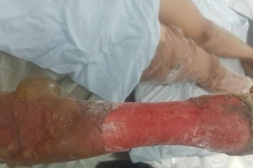 Cấp cứu kịp thời bệnh nhân bỏng nước sôi