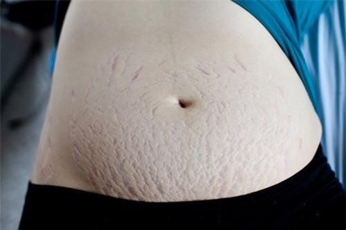 'Độc chiêu' giúp bạn trị rạn da cực nhanh