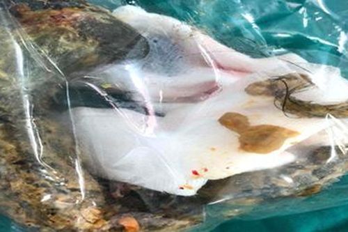 Bé gái tắc ruột vì 'ăn tóc'