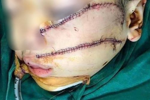 Những tình huống pháp lý vụ cha chém con trai 5 tuổi phải khâu 300 mũi