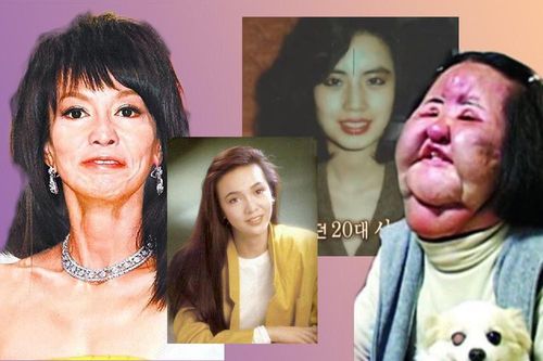 Những 'thảm họa dao kéo' của showbiz châu Á