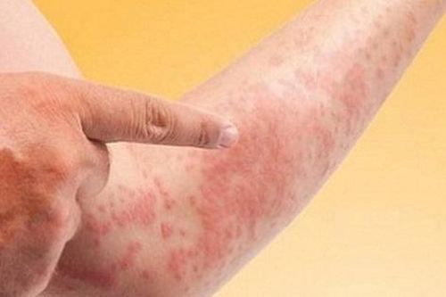 Cách phòng ngừa một số bệnh về da dễ nặng lên vào mùa đông