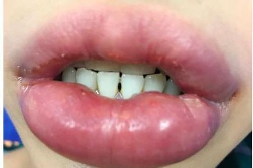 Nguy cơ mất Tết do làm đẹp 'cấp tốc'