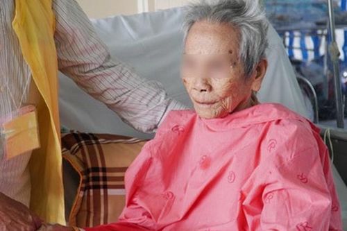 Thay khớp háng cho cụ bà 106 tuổi bị gãy cổ xương đùi
