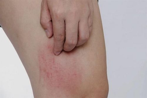 Khi dùng cetirizine trị dị ứng cần lưu ý gì?