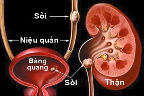 Biến chứng khó lường của sỏi niệu quản