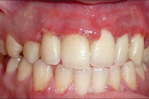 Viêm nướu loét hoại tử cấp tính (ANUG)