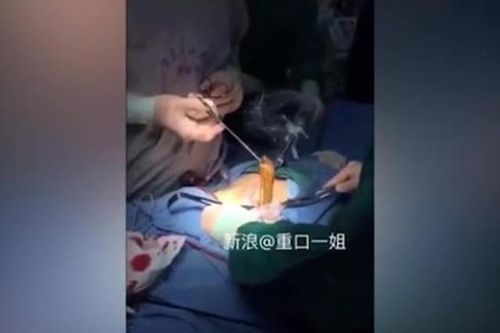 Kinh ngạc gắp lươn sống đang giãy trong bụng nam thanh niên