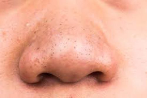 2 cách trị mụn đầu đen có thể bạn chưa biết