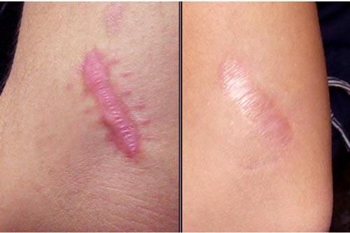 4 công thức chữa sẹo lồi tại nhà ai cũng làm được