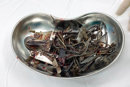 Trầm cảm, nam thanh niên ăn 1kg đinh, thìa, lưỡi dao, thỏi sắt