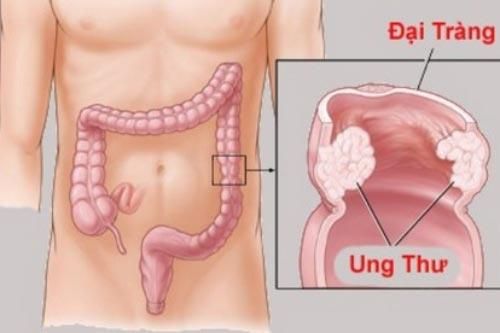 Dấu hiệu cảnh báo bệnh ung thư đại tràng