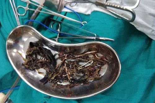 Thanh niên ở Bình Dương thích ăn kim loại: Bác sĩ lý giải nguyên nhân