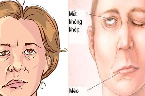 Bệnh nhân liệt mặt, méo miệng ngày lạnh tăng vọt, phòng tránh cách nào?