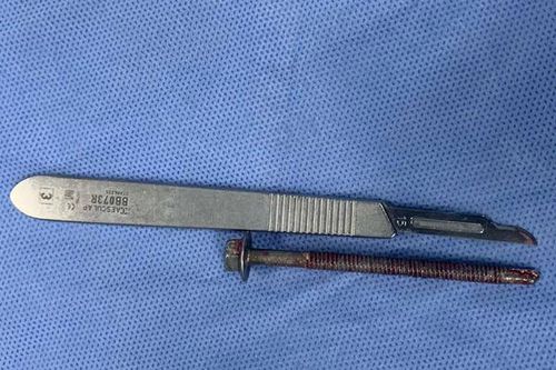 Uống rượu say, người đàn ông bị nhét ốc vít dài 6 cm vào niệu đạo
