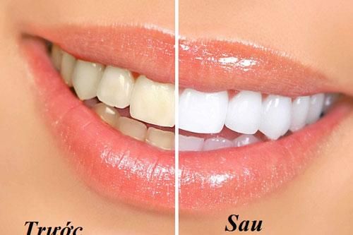 Mẹo nhỏ giúp bạn loại bỏ vết ố vàng trên răng