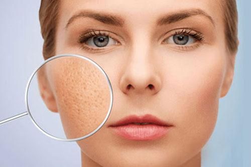 4 cách khắc phục tình trạng lỗ chân lông to, giúp da sáng mịn, tự tin đón Tết
