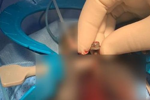 Hy hữu: Bị bạn nhậu nhét đinh vít dài 6cm vào niệu đạo