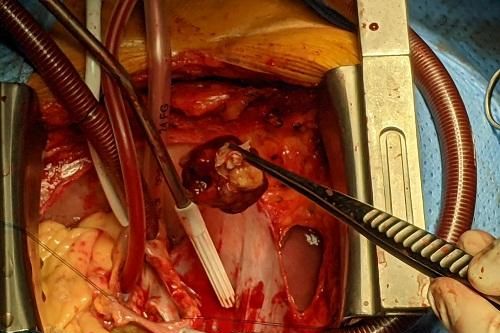 Bệnh nhân mắc u tim kèm hở van động mạch chủ