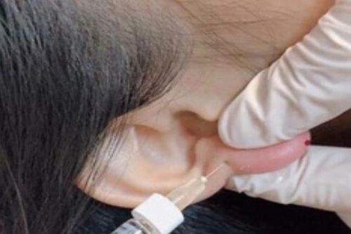 Đua nhau đi sửa dáng 'tai Phật' mong đổi vận, chị em nhận cái kết đắng