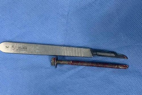 Nhậu say bị 'bạn nhậu' nhét đinh vít dài 6 cm trong niệu đạo