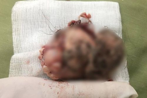 Hải Dương: Bé gái 7 tuổi có u quái chứa đầy răng và tóc trong ổ bụng
