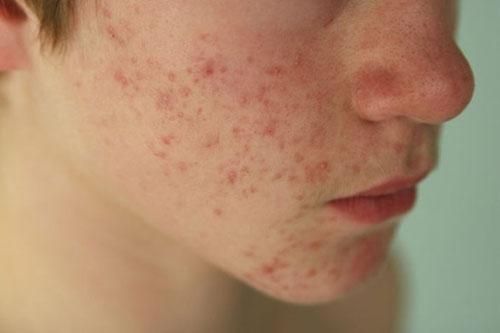 4 cách trị mụn trứng cá an toàn từ thiên nhiên