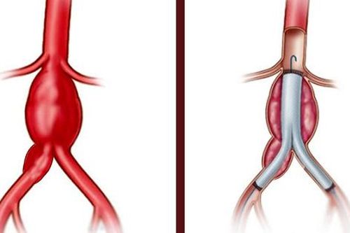 Cứu bệnh nhân vỡ phình động mạch chậu chung nguy hiểm tính mạng