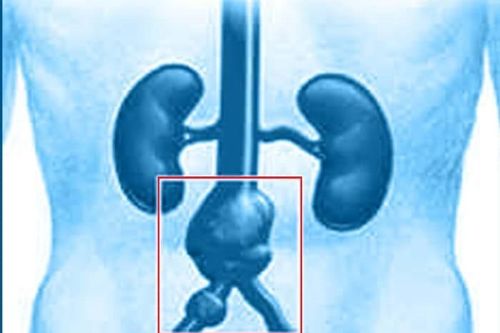 Kịp thời cứu cụ ông 83 tuổi bị vỡ phình động mạch chủ bụng