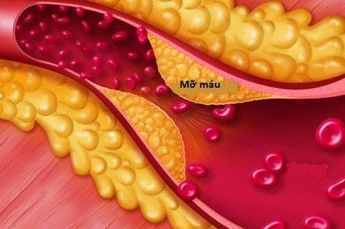 Rối loạn mỡ máu và biến chứng