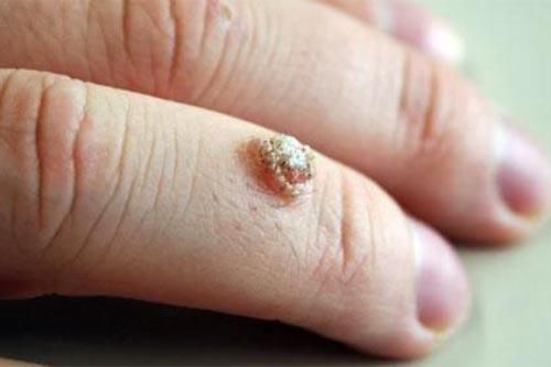 Những điều bạn phải biết về mụn cóc