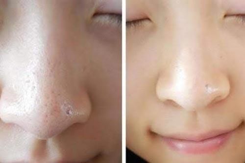 4 mẹo se lỗ chân lông tại nhà